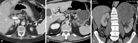 Ct And Mr Imaging Of The Adrenal Glands In Cortisol Secreting Tumors