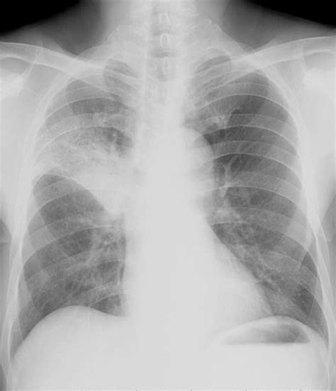 A Chest X Ray Revealed Consolidation Of The Right Upper Lung Field