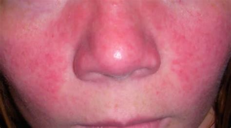 Lupus Rash On Face