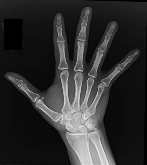 Broken Finger X Ray