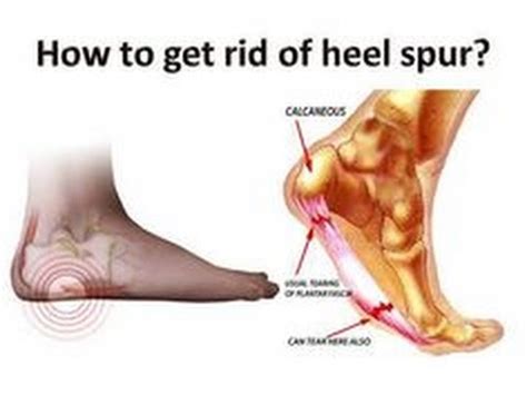 This is most commonly related to achilles tendinitis, but this can lead to heel spurs, bone problems and even the bursa sharp pain in the back of the heel, this is from nerve irritation. Heel spurs natural treatment!Health Tips - YouTube
