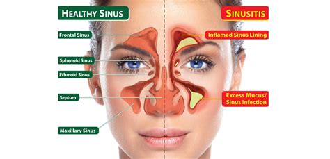 Runny Nose Difficulty Breathing Headache Fatigue Or Facial Pains