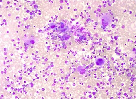 Chronic Myeloid Leukaemia With Extreme Thrombocytosis Bmj Case Reports