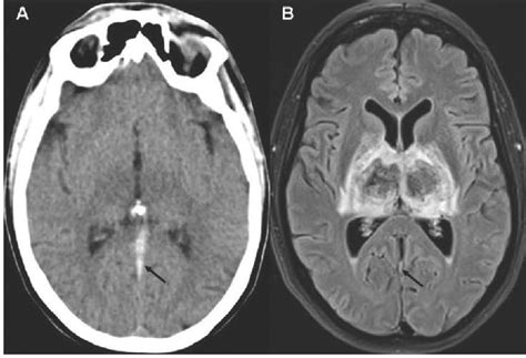 Bilateral Thalamic Infarction The Western Journal Of Emergency Medicine