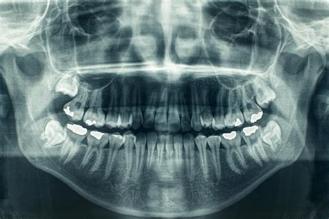 Gums Of Mouth Cancer X Ray