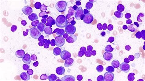 Multiple myeloma is the second most common type of blood cancer after leukemia. La inmunoterapia T CAR también es eficaz en el tratamiento ...