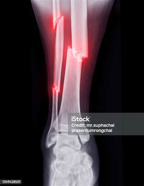 Xray Image Of Ankle Joint Showing Fracture Tibia And Fibula Bone Stock
