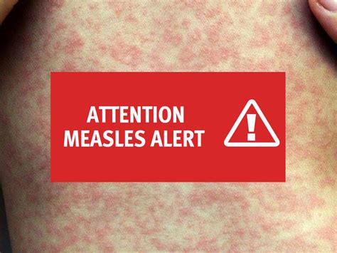 Measles Alert For Brisbane Redcliffe Hospital