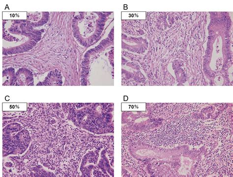 Tumor Infiltrating Immune Cells In Hande Stained Sections Of Colorectal