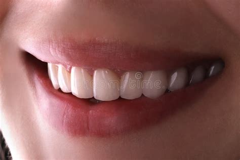 Perfect Healthy Teeth Beautiful Wide Smile Bleaching Procedure