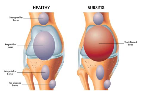 Knee Bursa In Real Human Body Hot Sex Picture