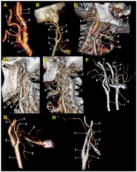 Medicina Free Full Text Vertical Levels Of The Occipital Artery Origin