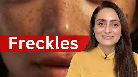 Freckles Causes Treatment Recommendations Dermatologist Youtube