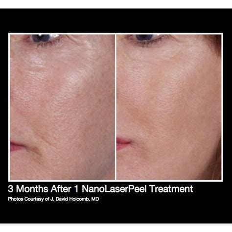 Contour Trl Nano Laser Peel Patrick L Basile Md Plastic Surgery