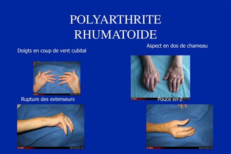 Ppt Polyarthrite Rhumatoïde Olivier Brocq Service Rhumatologie
