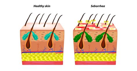 All About Seborrheic Alopecia What It Is And How To Treat It