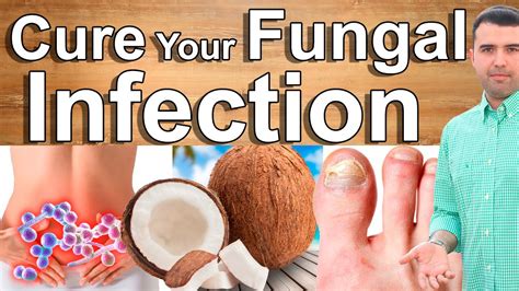 Eliminate Fungal Infections With These Home Remedies Say Goodbye