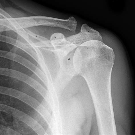 Acromioclavicular Joint Dislocation X Ray