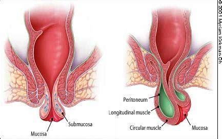 However, i have read on the internet that if a thrombosed external hemorrhoid is over 72 hours old, doctors usually conclude that it sounds like a thrombosed hemorrhoid to me, and those are painful. ბუასილის ( ჰემოროის ) სამკურნალოდ გთავაზობთ ხალხურ ...