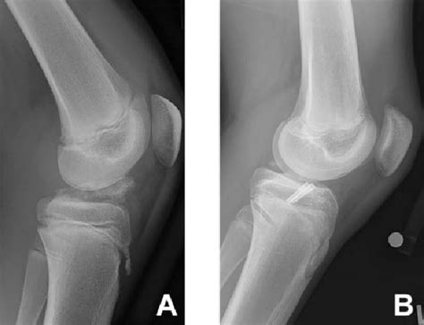 Example Of A Type 4 Tibial Eminence Fracture A Preoperatively And B
