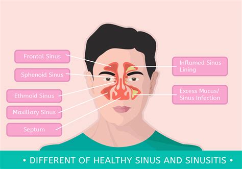 Different Of Healthy Sinus And Sinusitis 183839 Vector Art At Vecteezy