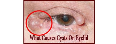 What Causes A Cyst On My Eyelid Quora