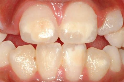 Molar Incisor Hypomineralisation Mihin Your Childs Teeth Newcastle