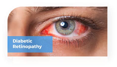 Diabetic Retinopathy Eye Doctors