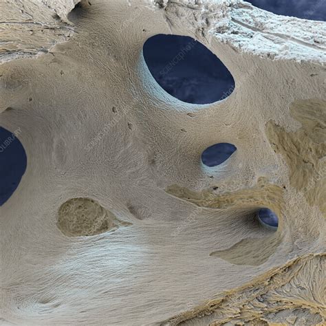 Osteoporosis Sem Stock Image M2300475 Science Photo Library