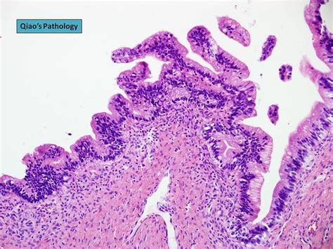 Qiao's Pathology: Mucinous Borderline Tumor of Ovary ...