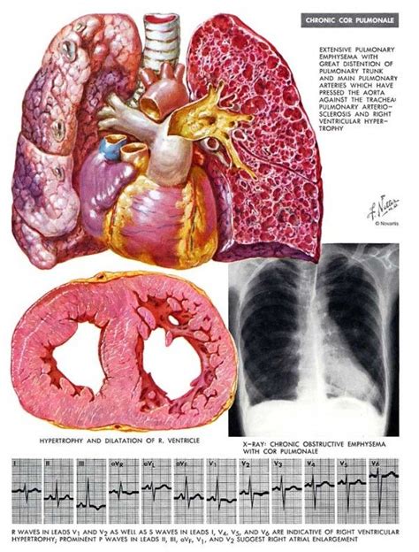 Pulmonary Heart Disease Pulmonary Heart Disease Pulmonary Heart Disease