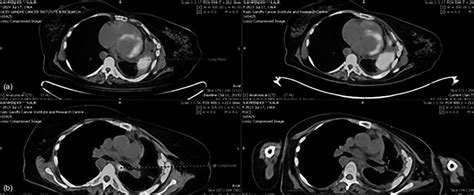 PET CT Images Showing A Progressive Lung Mass In January 2016 And B