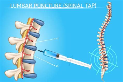 6 Side Effects Of Lumbar Puncture Spinal Tap In Babies In 2022