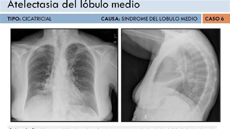 Figure 11 From Revisión De Los Signos Radiológicos De Atelectasia