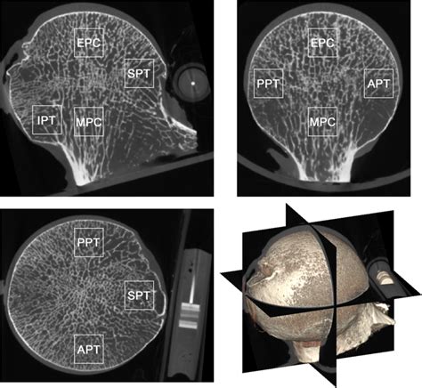 A Cross Sectional Study On The Age Related Cortical And Trabecular Bone