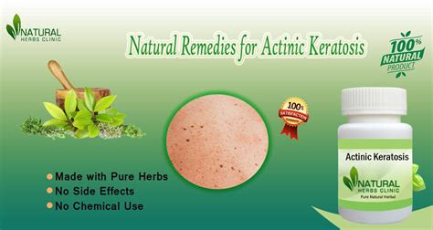 Actinic Keratosis Here Are Best Remedies To Manage Skin Disease