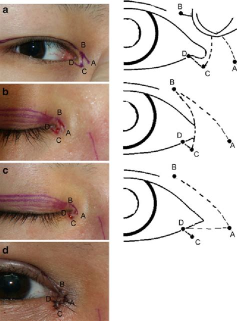 Epicanthal Folds Surgery Best Eyelid Surgery In Korea Jws Dual