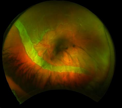 Giant Retinal Tear Retina Image Bank