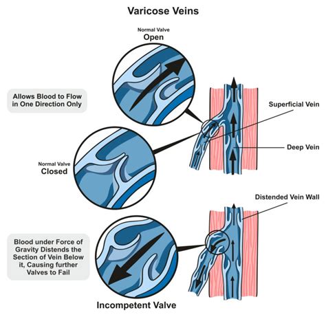 Superficial Venous Reflux Disease Treatment St Augustine Fl