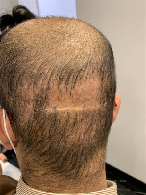 Greffe de cheveux ratée : 7 signes évidents (et d’autres moins) - The