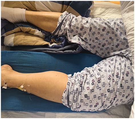 Photograph Showing The Patients Swollen Left Leg Download