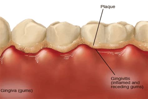 The Symptoms Treatment And Prevention Of Gingivitis Dental Depot