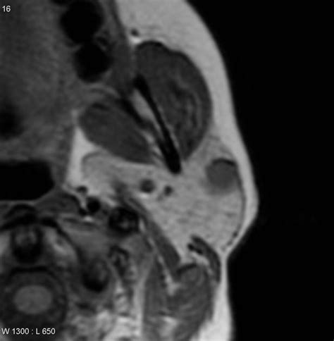 Salivary Gland Tumor Mri Wikidoc