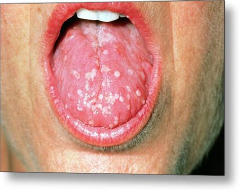 Tongue Blisters Due To The Herpes Simplex Virus Photograph By Dr P