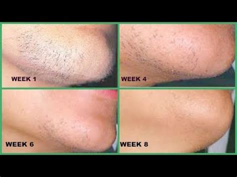 Having stray facial hairs is very common for women, says arash akhavan, md, a new york city. DON'T SHAVE, REMOVE CHIN HAIR AND UPPER LIPS HAIR FOR GOOD ...