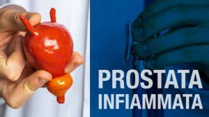 Infiammazione Alla Prostata Sintomi Cause E Cura C D V