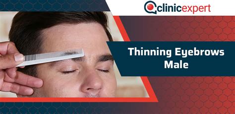 Male Eyebrow Thinning Causes Treatments And Solutions Clinicexpert