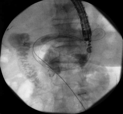 Bypassing The Bypass Eus Directed Transgastric Ercp For Roux En Y