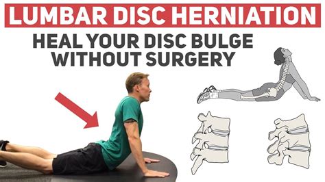 Heal Your Disc Herniation Without Surgery Youtube