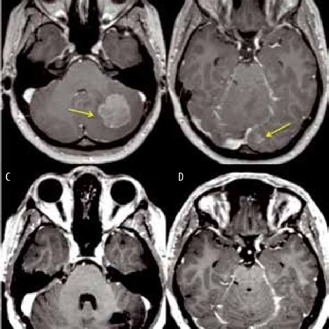 Mri Of A Patient With Multiple Brain Metastases Arrows Pre A D And